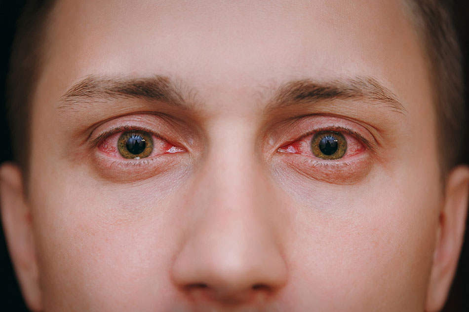 Can I Wear Contacts With Pink Eye? What are my options? - LensPure
