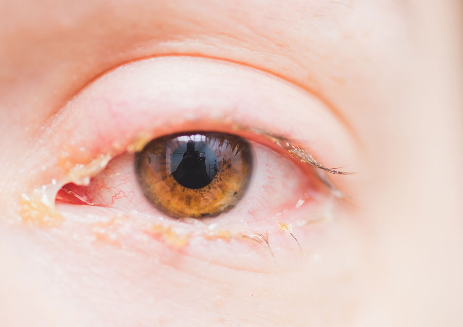 Close up of eye with conjunctivitis