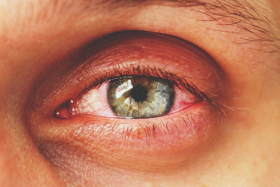 Close-up of infected eye