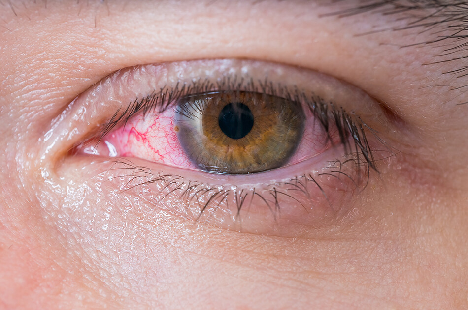 closeup eye infection