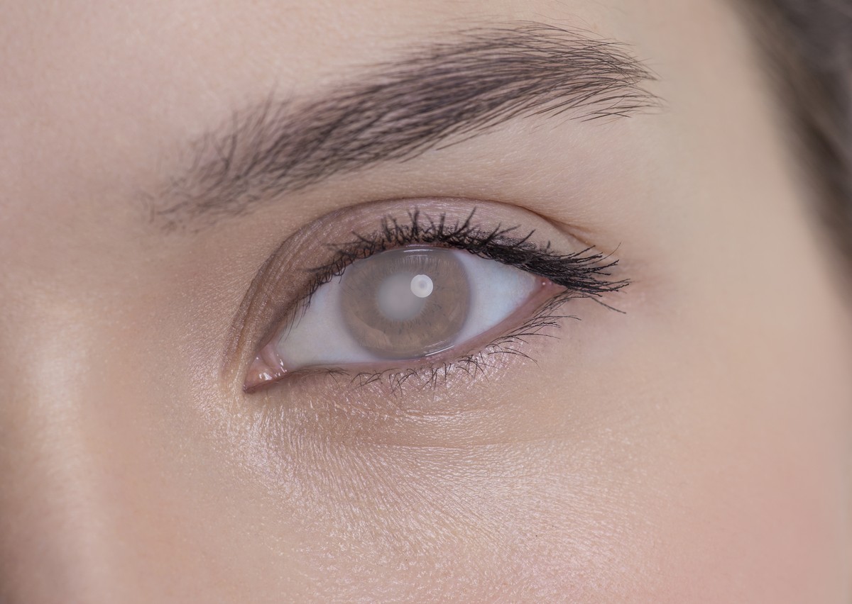 Close-up of young woman’s eye with a cataract