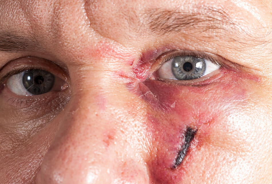 man with eye injury