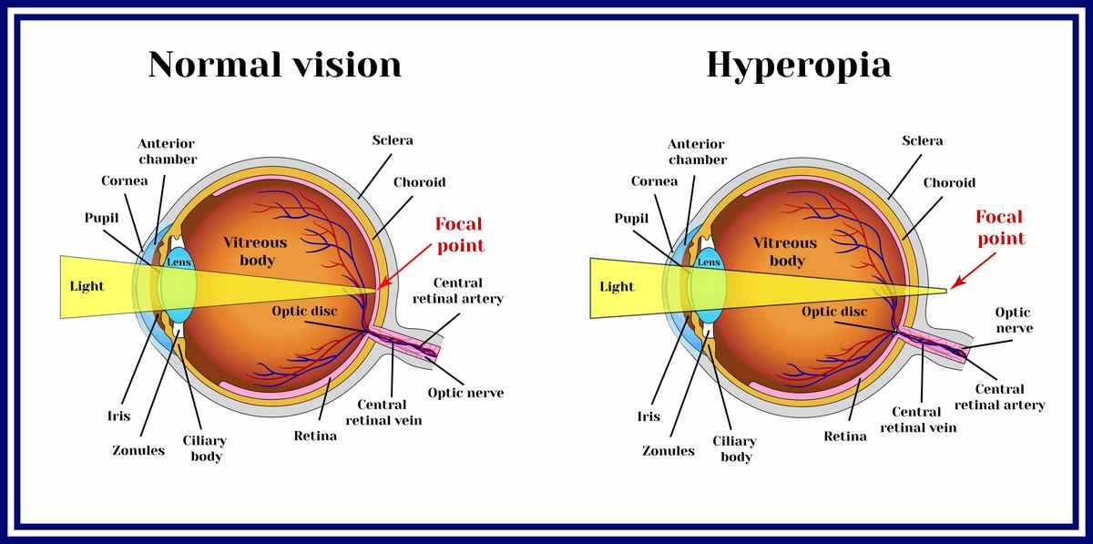 All about hyperopia!