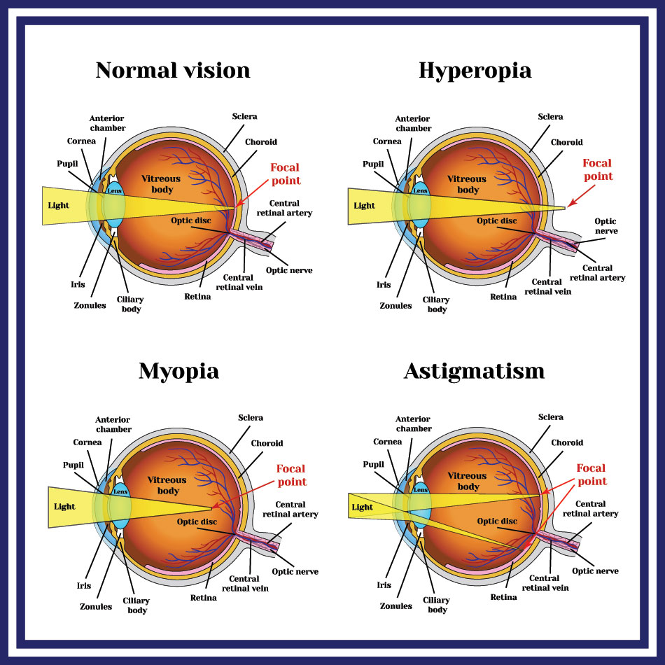 Infographic of vision problems