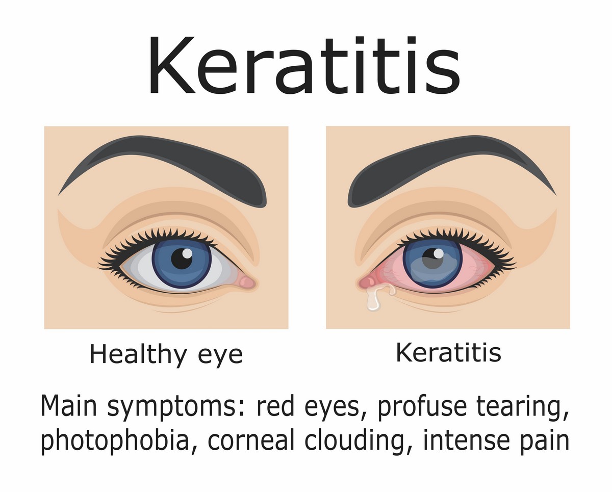 keratitis in healthy vs infected eye