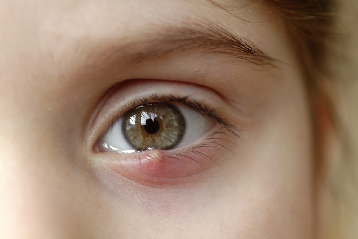 closeup of a young person with a stye on their bottom eyelid