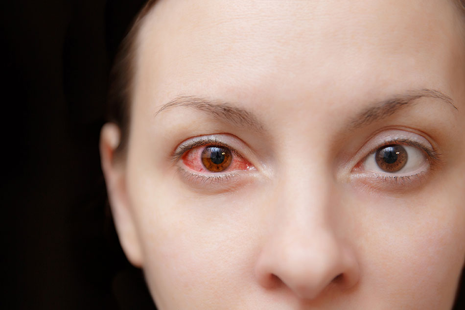 Woman with one healthy eye and one infected eye